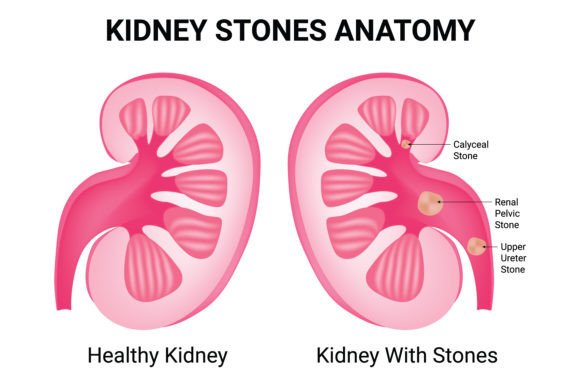 Download Kidney Stones Anatomy Science Design - Stone Collection